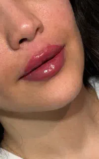 جشنواره تخفیفات فیلر بوتاکس پی آر پی مزو