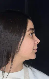 عمل جراحی بینی متخصص گوش حلق وبینی /باهزینه پارسال