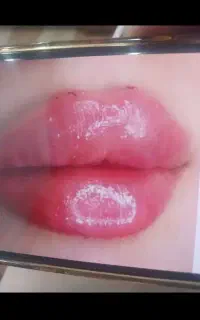 تزریق ژل وبوتاکس