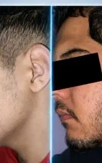 رویش مجدد مو و ریش 33 روزه