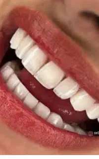 کامپوزیت طبیعی با تکنیک لیرینگ