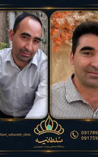 کاشت مو به همراه شقیقه و خط رویش کاملا طبیعی