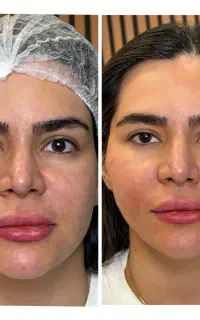 لیفت صورت با نخِ جوانساز توسط دکتر چالشی، اقساط