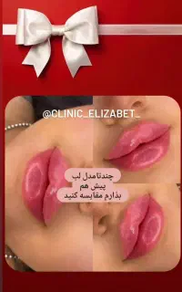 ژل لب / کرج/ بوتاکس چشم گربه ای / فیلر /مادلینگ