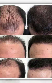بدون کاشت مو هدیه بگیر
