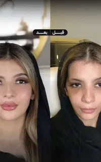 تزریق ژل و بوتاکس و‌پی آرپی لیفت صورت و اصلاح بینی