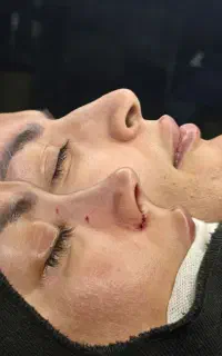 جراحی بینی به روش مدرن (SEG)
