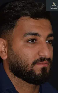 جراحی زیبایی صورت و بینی ۴۵ملیون