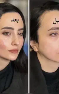 لیفت صورت نخ ،ژل لب بوتاکس چربی سوز لیزرمو prp