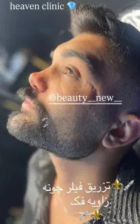 فیلر و بوتاکس