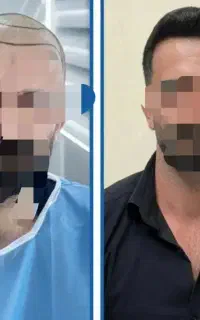کاشت مو اقساطی باگارانتی مادام العمر کتبی