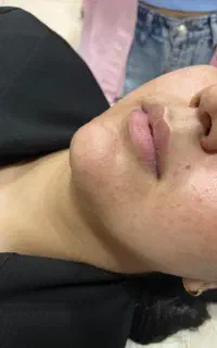 تزریق ژل و بوتاکس