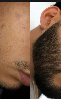 دیگه مشکل ریش باقی نمیمونه