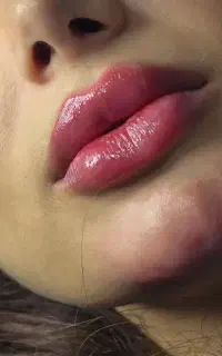 ژل بوتاکس