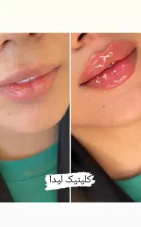 جشنواره ویژه ژل لب فیلر1050بوتاکس950 پزشک متخصص