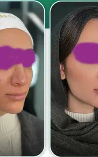 بایو فیلر متد اروپایی کلینیک فرحزاد
