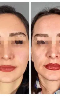 جوانساز دائمی بدون بازگشت