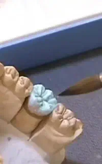 آموزش پودرگذاری دندان