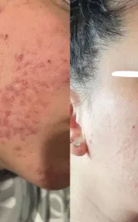 ضدجوش قوی ، پاکسازی عمیق