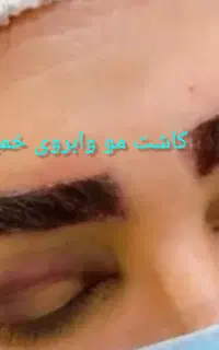 کاشت مو، ابرو، ریش در شهر خمین