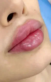 مدل ژل و بوتاکس رایگان