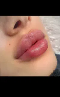 تزریق ژل لب گونه زاویه بوتاکس
