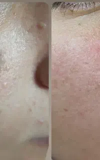 بوتاکس،ژل،مزوتراپی و خدمات زیبایی