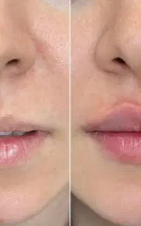 فیلر بوتاکس