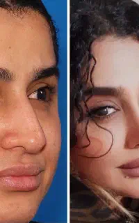 جشنواره عمل بینی فقط با ۳۵ میلیون