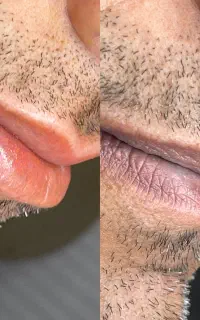از بین بردن کبودی و تیرگی لب