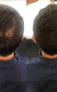 دیگه ریزش مو بسته