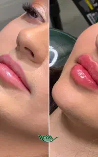 جشنواره بهاره فیلر لب و بوتاکس با تخفیف فوق العاده
