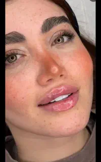 فیلر بوتاکس انزیم مزو هایفو روشن کنندگی جوانسازی