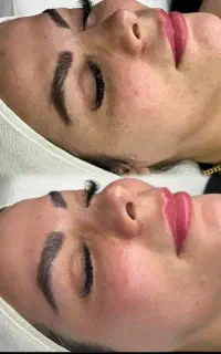 فیشیال و هایفوتراپی تخصصی
