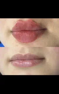 فیلر/بوتاکس /چال گونه/میکرودرمال /پرسینگ