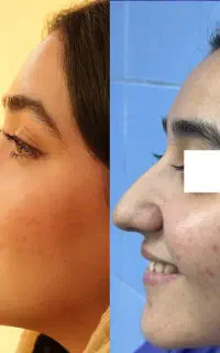 جراحی بینی تخصصی ،باقیمت ویژه،۵۰درصد آف در تهران