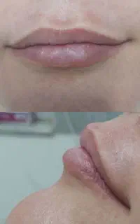 تزریق فیلر چربی ساکشن فیلر بادی