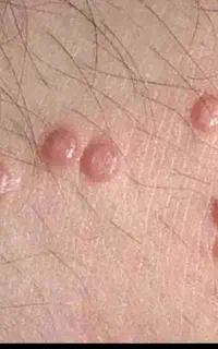 لیزر زگیل تناسلی و خالبرداری در ایلام