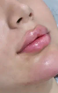 آموزش تزریق ژل بدون سوزن ،بدون هزینه خودت ژل بزن