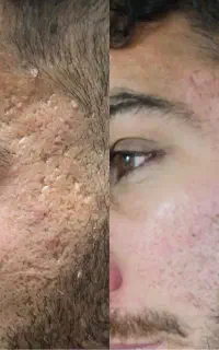 از بین بردن لک و فرورفتگی صورت