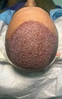 کاشت مو به روش شیراز اقساطی