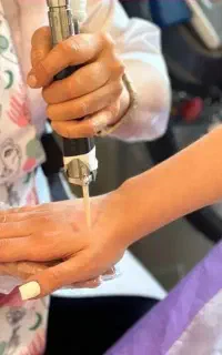 لیزرموهای زائد(قطعی)
