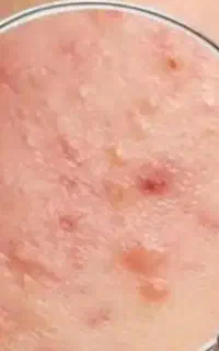 کرم ضد جوش جای جوش و لک قهوه ای اصل