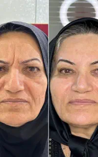 خدمات تخصصی بوتاکس با تخفیف ویژه در احمد اباد