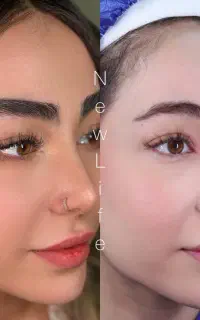 میکرو لیفت کاشت ابرو