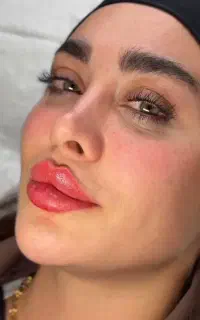 تزریق فیلر و بوتاکس