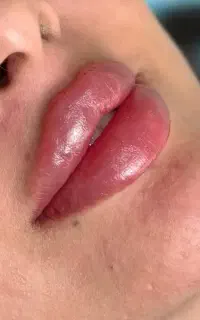 ژل و بوتاکس با ۵ سال سابقه حرفه ای