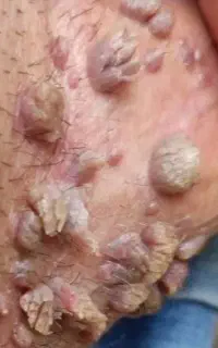 درمان زگیل و تبخال نواحی خصوصی