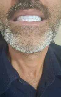 دندانسازی منبری