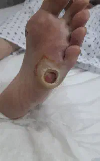 پانسمان تخصصی زخم و استومی